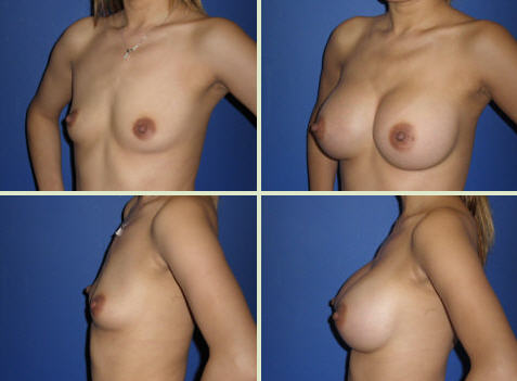 breast augmentation michigan
