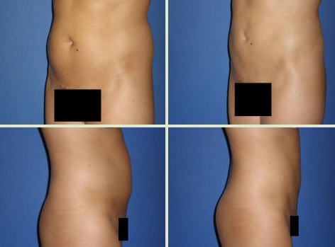liposuction before and after photos of a patient from michigan